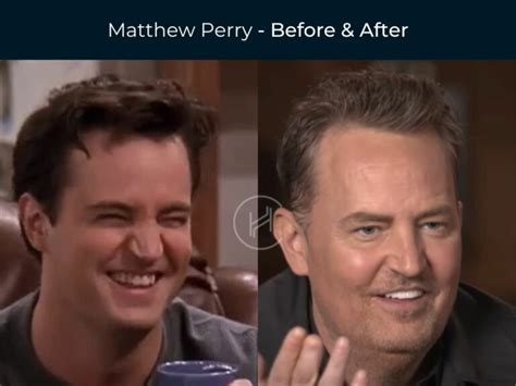 are matthew perrys teeth fake